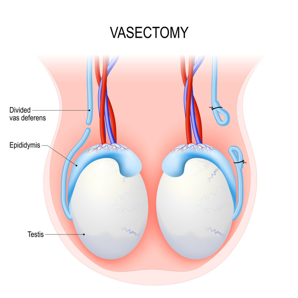 Vasectomia em Curitiba - Mark Neumaier Urologista e Cirurgiao