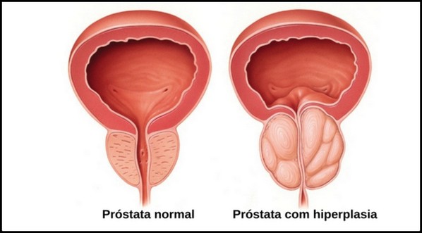 hiperplasia prostatica benigna hpb - tratamento com neumaier urologia