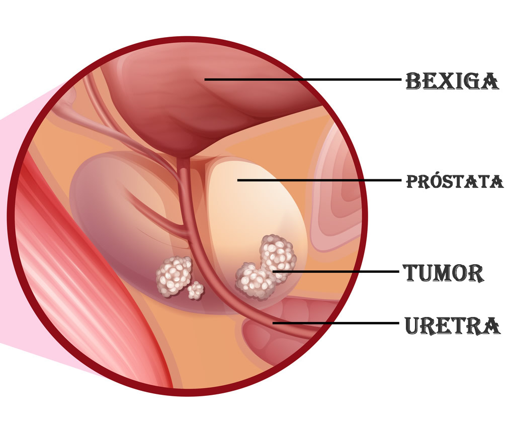 Cancer de Bexiga em Curitiba - Mark Neumaier Urologista