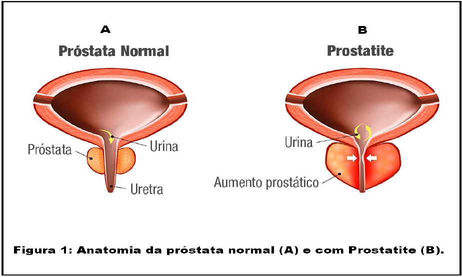 Prostatite em Curitiba - Mark Neumaier Urologia