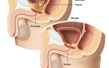 Cancer de Prostata em Curitiba - Mark Neumaier Urologista