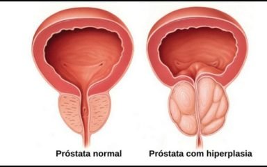 hiperplasia prostatica benigna hpb - tratamento com neumaier urologia